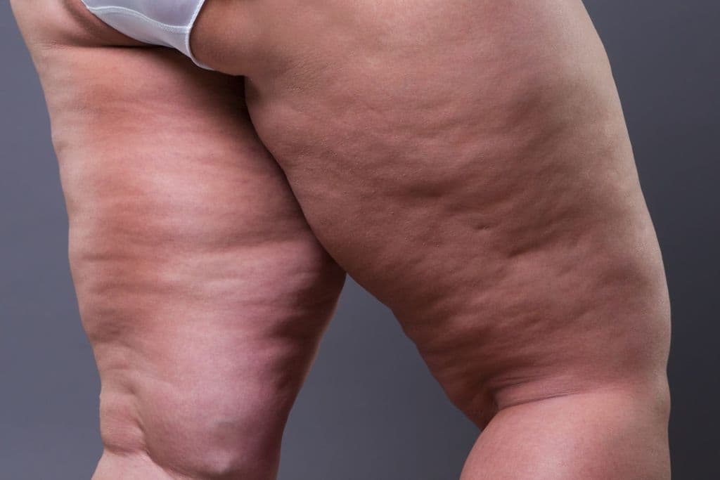 Lipödem-Behandlung: Welcher Arzt bietet die besten Lösungen?